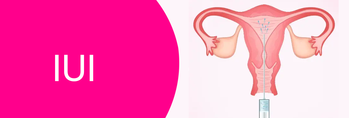 IUI at Laimaa Fertility, Delhi
