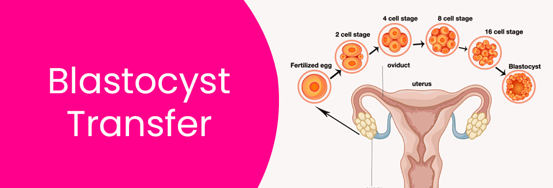 Blastocyst Transfer at Laimaa Fertility, Delhi